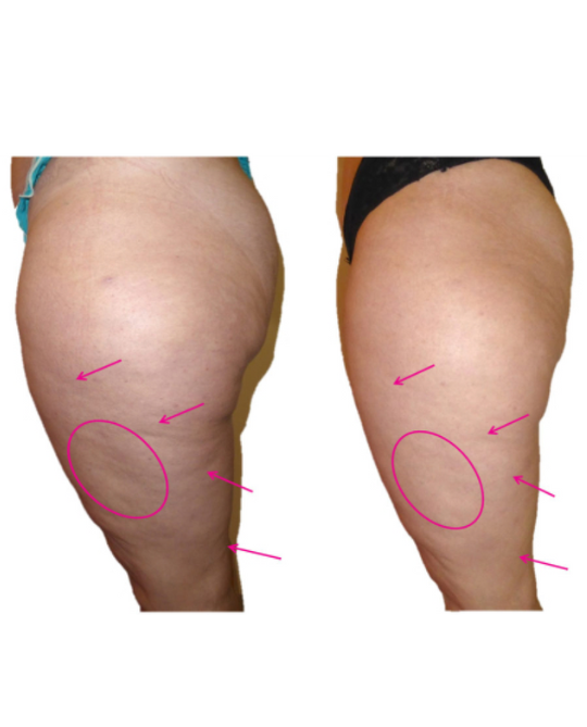 MyCollagenLift