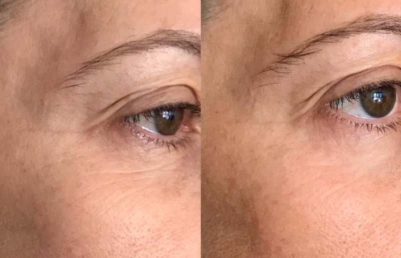 Contour des yeux