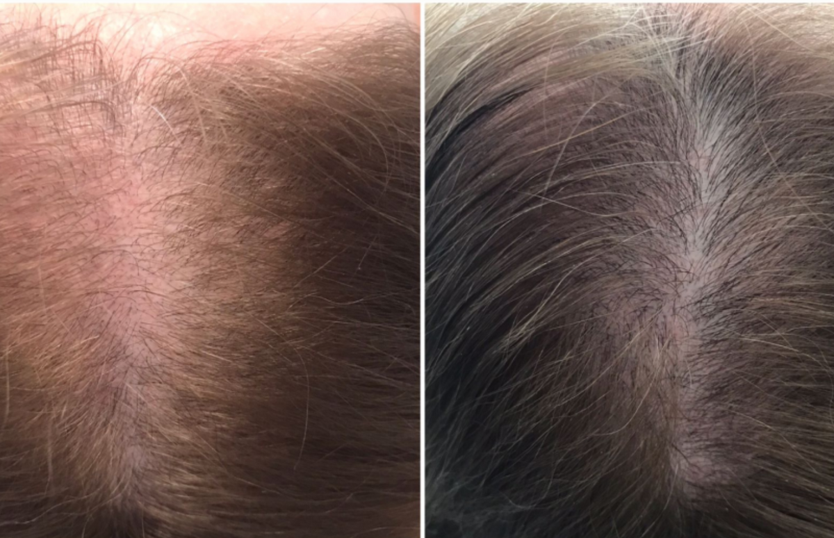 Top of the skull / Central parting - Before