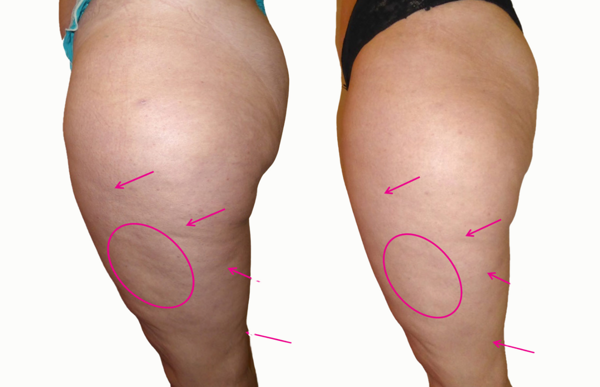 Thigh - Before