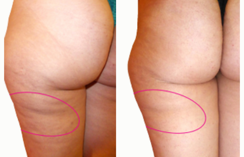 Cuisse postérieure