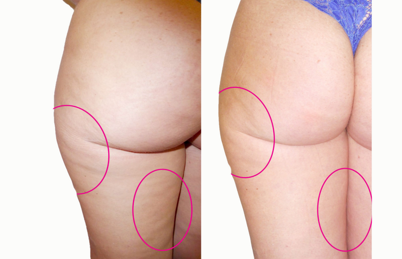 Fessier et haut des cuisses