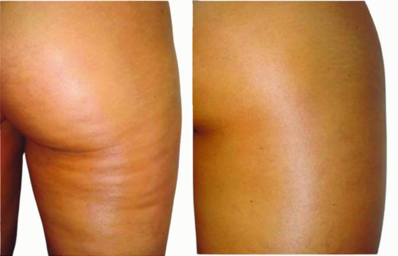 Thigh elasticity