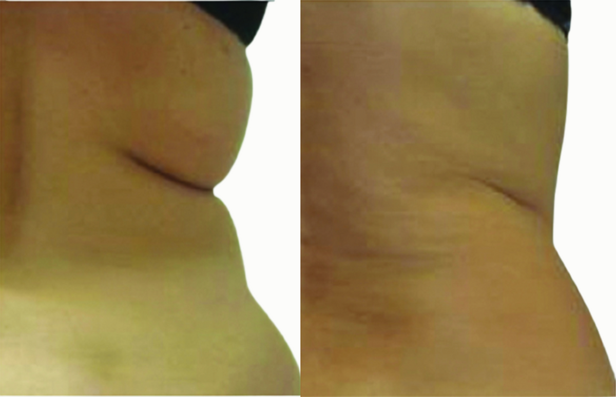 Lumbar area and love handles - Before