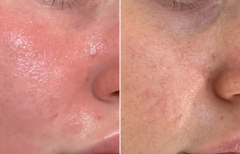 Acné, rougeurs et eczéma visiblement réduits