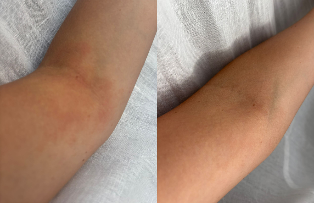 Eczema on the arm - Before